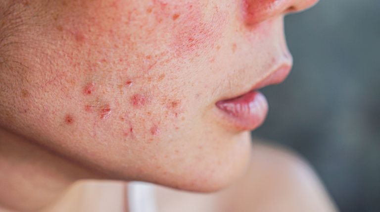 Signos de piel sensible con enrojecimiento e irritación