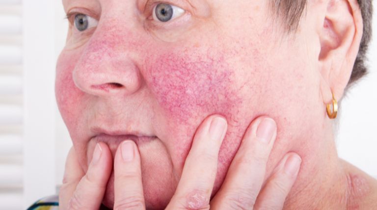 sintomas de piel sensible con enrojecimiento e irritación