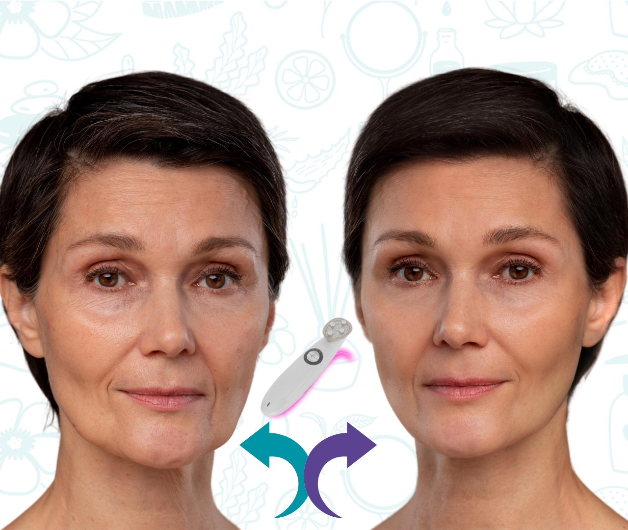 Resultado de un tratamiento de microdermoabrasión facial antes y después, mostrando una piel rejuvenecida y libre de imperfecciones.