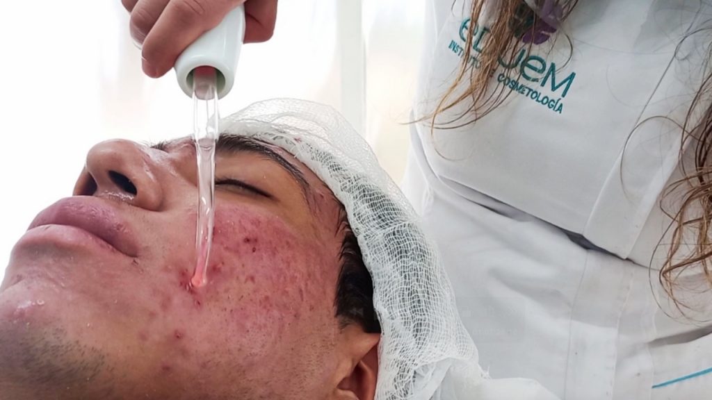 Tratamiento con alta frecuencia para acné