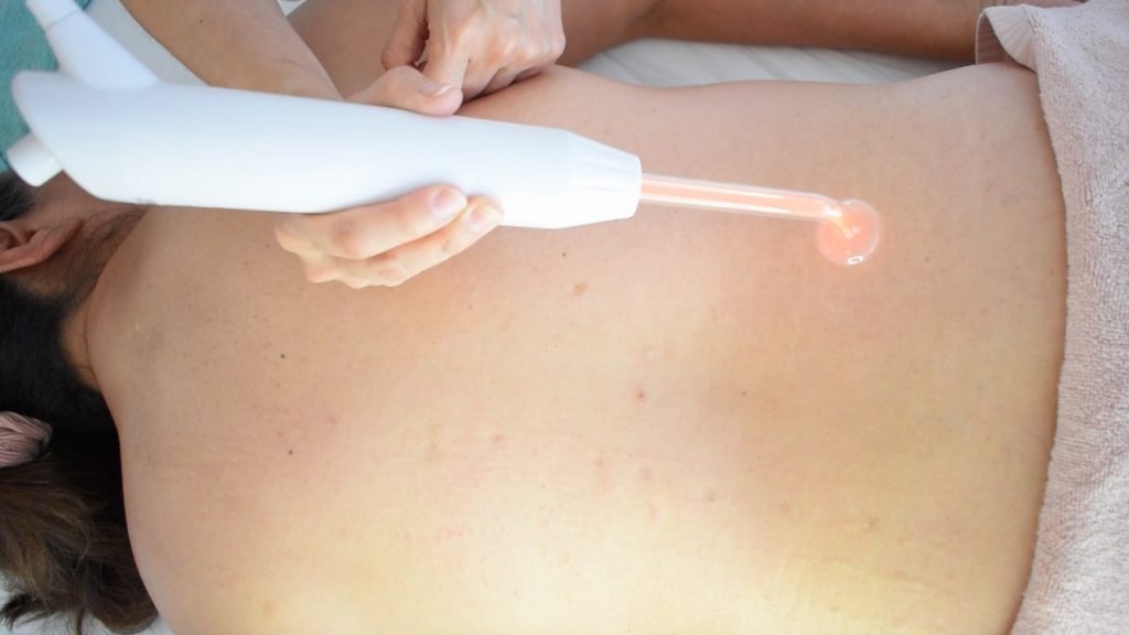 Aplicación de chisporroteo con electrodo de hongo en tratamiento de espalda.