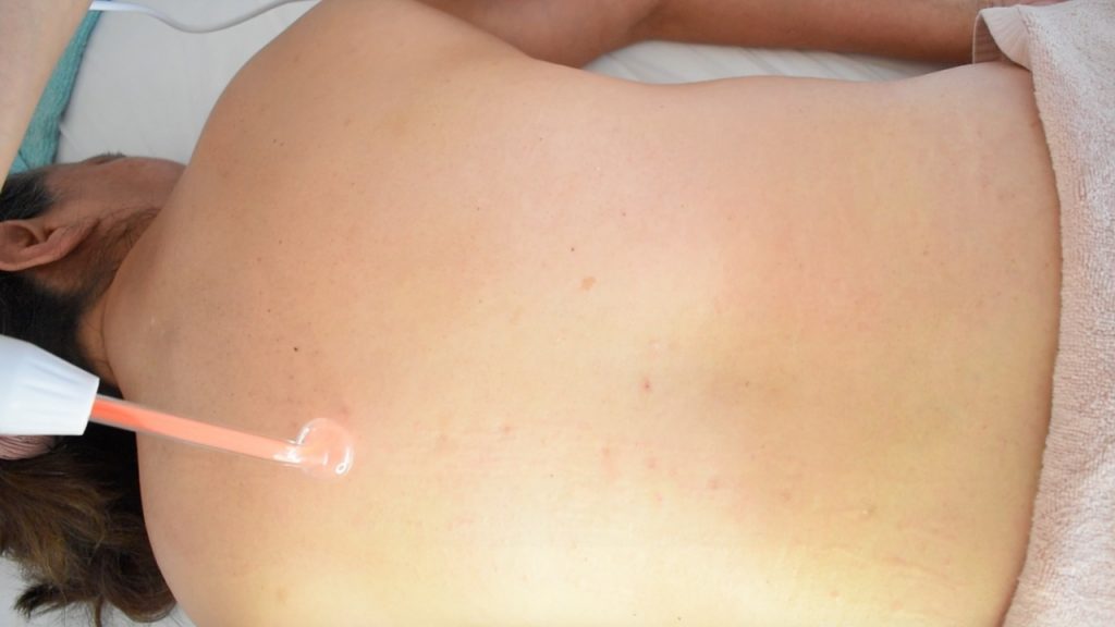 Tratamiento corporal de espalda utilizando aparato de alta frecuencia.