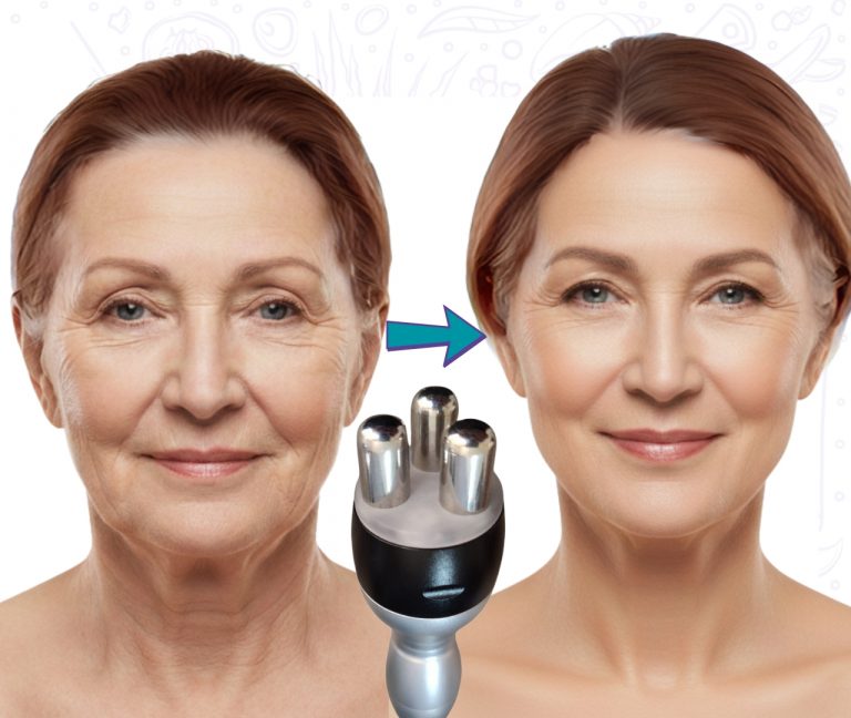 Comparación antes y después de un tratamiento de radiofrecuencia facial que muestra la reducción de arrugas y el rejuvenecimiento de la piel en una mujer adulta.