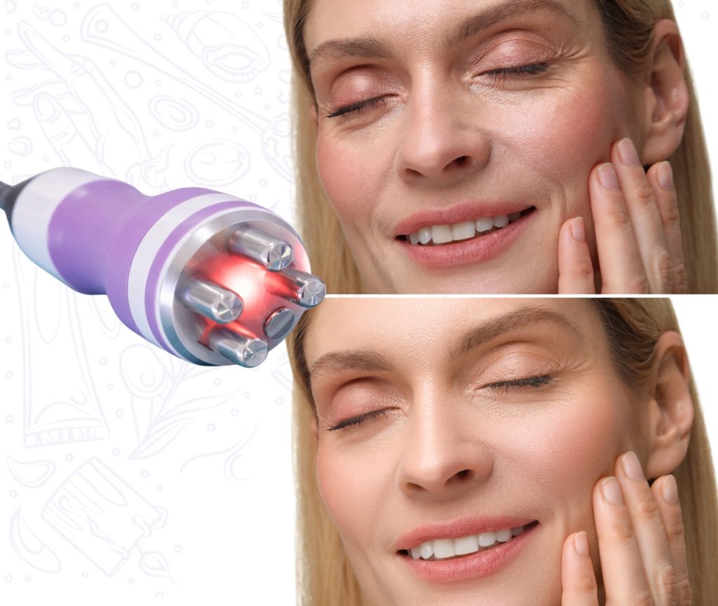 Equipo profesional de radiofrecuencia facial utilizado para tratamientos de lifting y rejuvenecimiento sin cirugía.