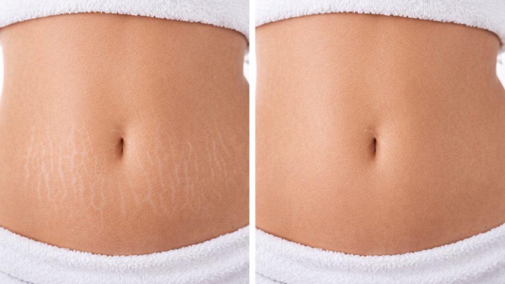 Comparación de abdomen con estrías y resultado posterior al tratamiento con ultrasonido
