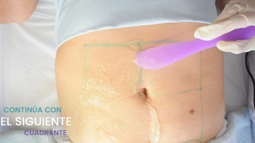 Continuidad del tratamiento de ultrasonido pasando al siguiente cuadrante abdominal