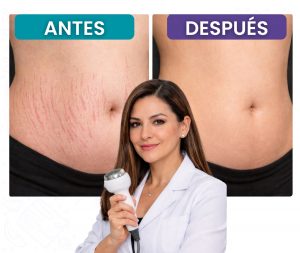 Comparación antes y después del tratamiento para eliminar estrías del abdomen con ultrasonido estético