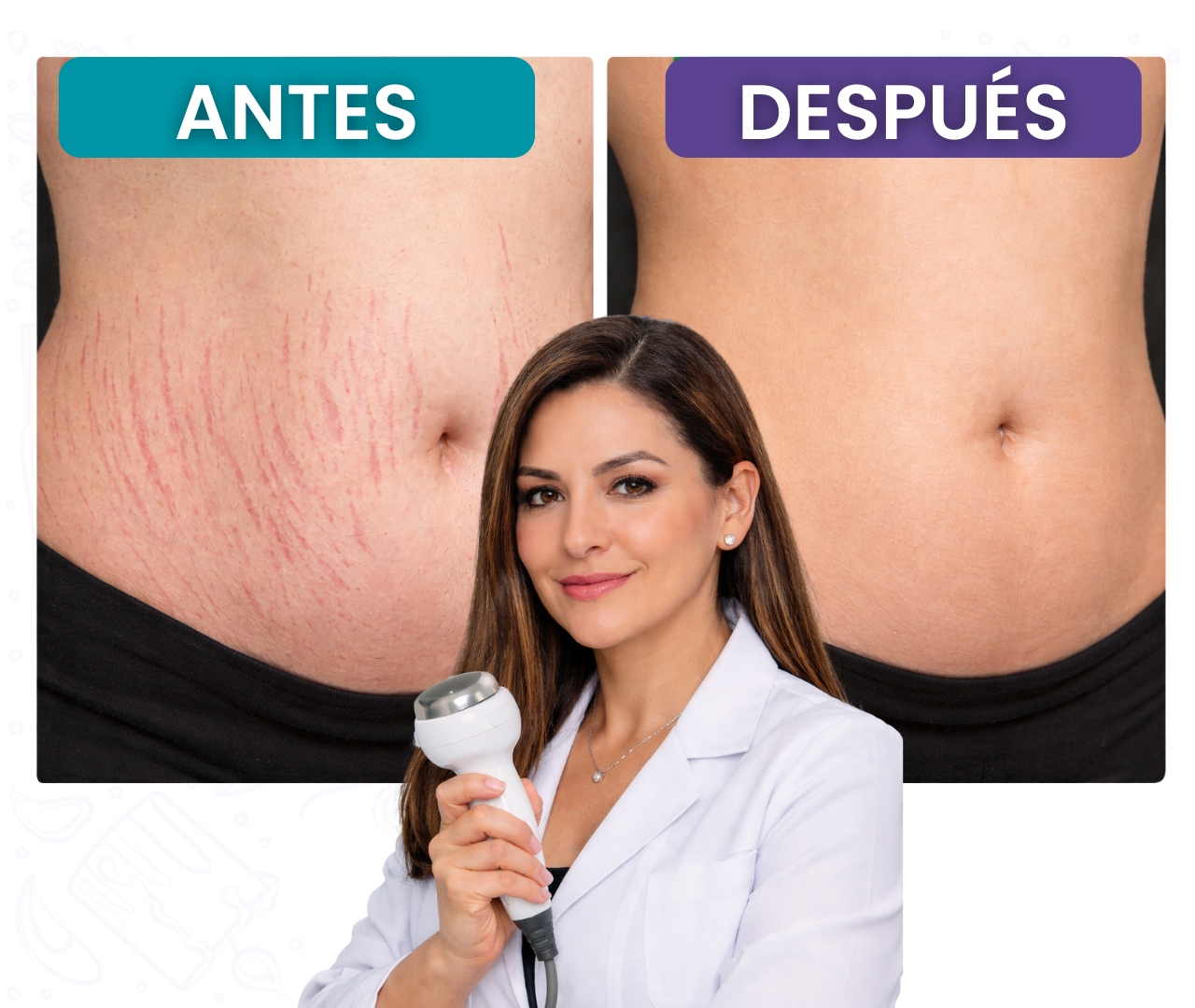 Comparación antes y después del tratamiento para eliminar estrías del abdomen con ultrasonido estético