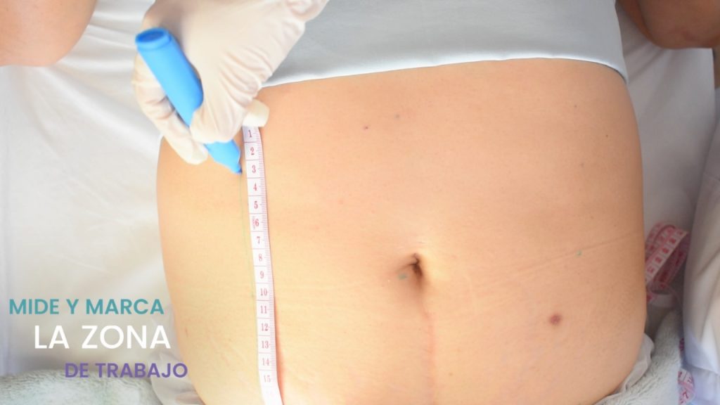 Medición y delimitación del abdomen en cuadrantes para aplicación uniforme de ultrasonido