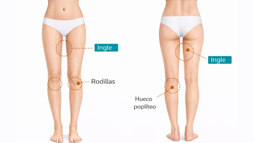 Zonas del cuerpo que se deben evitar durante tratamientos de radiofrecuencia en piernas como ingle, rodillas y hueco poplíteo