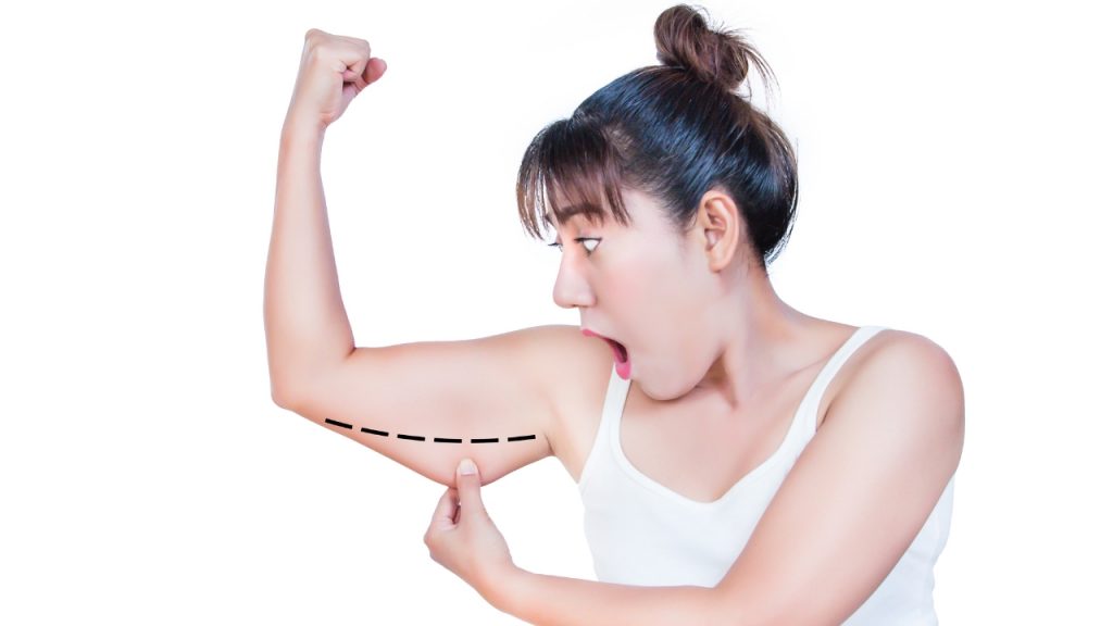 Ejemplo de flacidez en brazos, una de las principales preocupaciones tratadas con radiofrecuencia corporal.