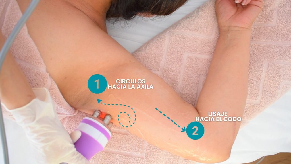 Aplicación de radiofrecuencia corporal en brazos con movimientos controlados para estimular colágeno y reafirmar la piel.