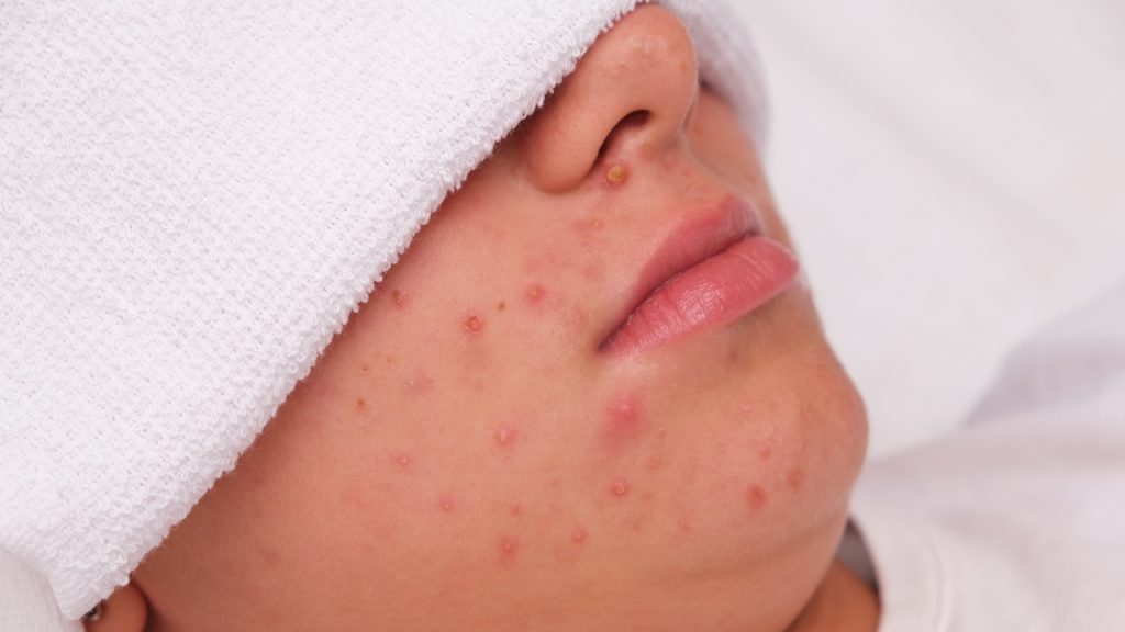 Primer plano de piel con acné mostrando pápulas y pústulas antes de tratamiento facial