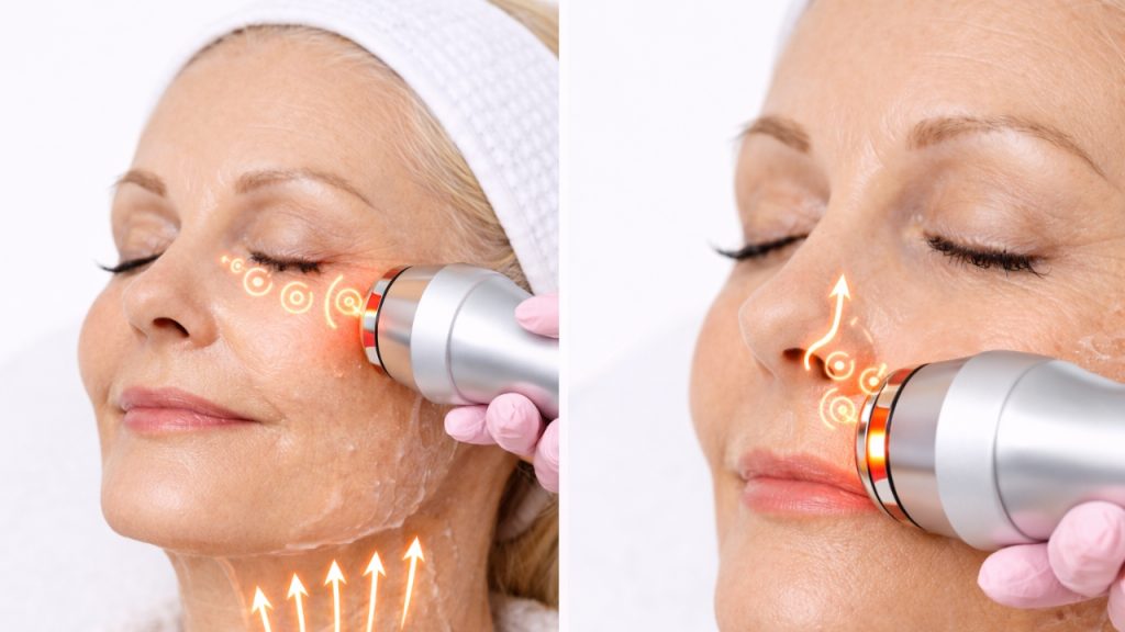 Aplicación precisa de radiofrecuencia facial en zonas delicadas como nariz evitando el área ocular