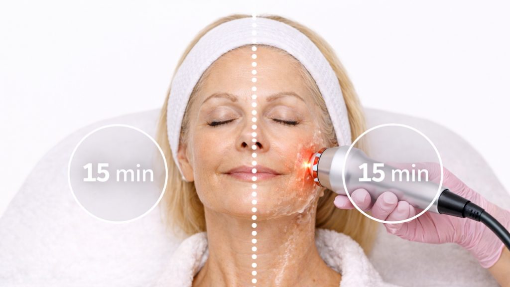 Distribución del tiempo en radiofrecuencia facial dividiendo el rostro en dos zonas iguales
