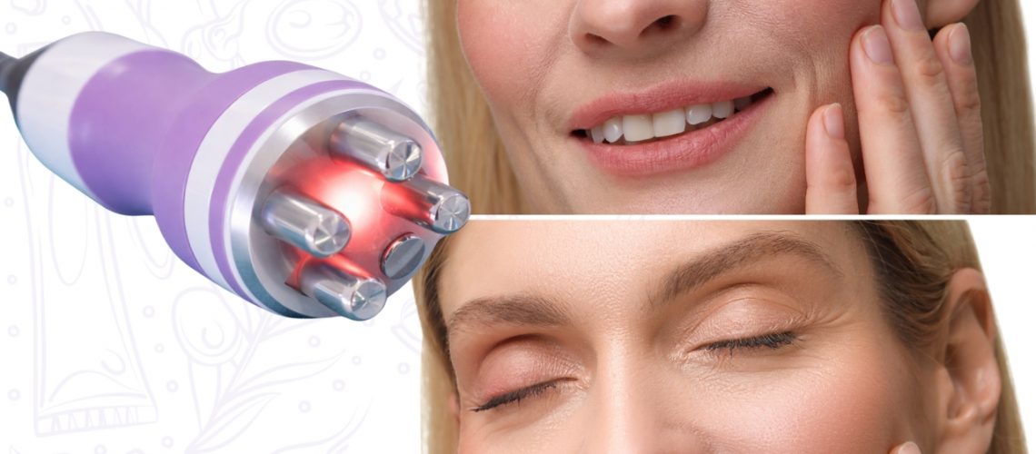 Equipo profesional de radiofrecuencia facial utilizado para tratamientos de lifting y rejuvenecimiento sin cirugía.